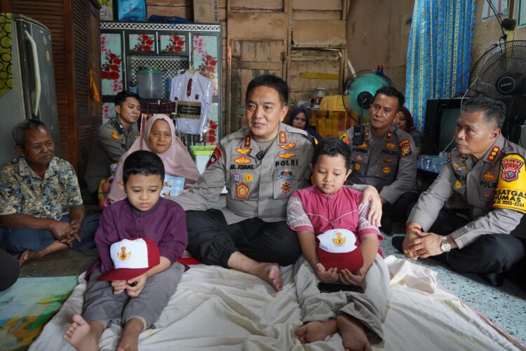 Dibiayai Jenderal Bintang 2, Adik-Kakak Penderita Tulang Kaca di Pekanbaru Berangsur Pulih
